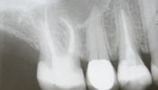 Zahn nach thermoplastischer Wurzelfüllung- orthoradial